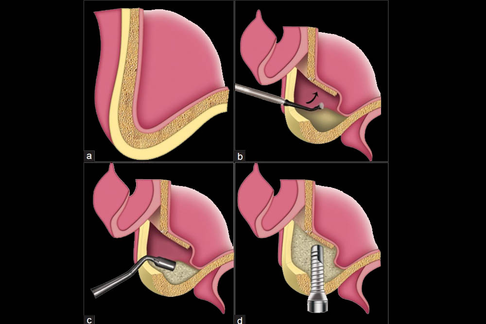 Indirect/ Direct Sinus Lifts
