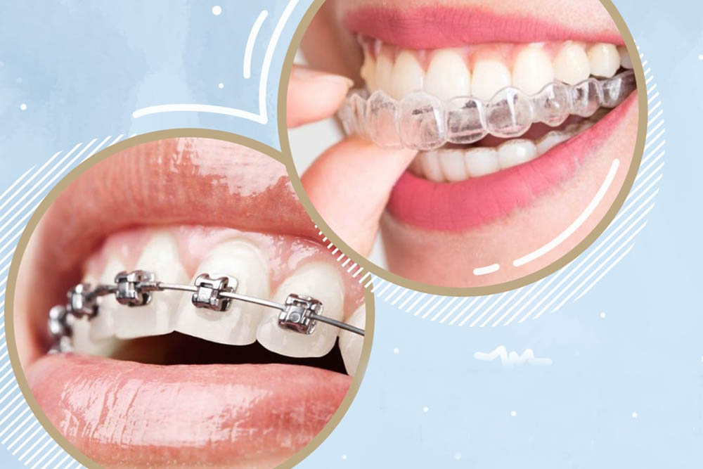 Ortho braces & Clear Aligners
